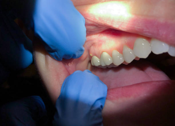 Best Emergency Tooth Extraction in Grovetown, GA